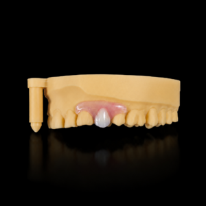 Nesbit Flexible Partial Denture
