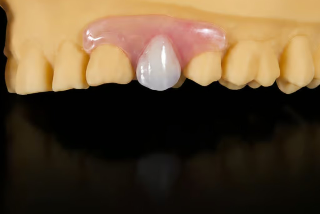 Nesbit partial denture close-up on dental model